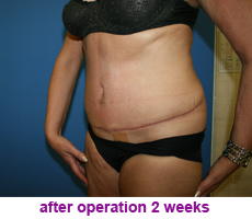 plastic-surgery-tummy-tuck